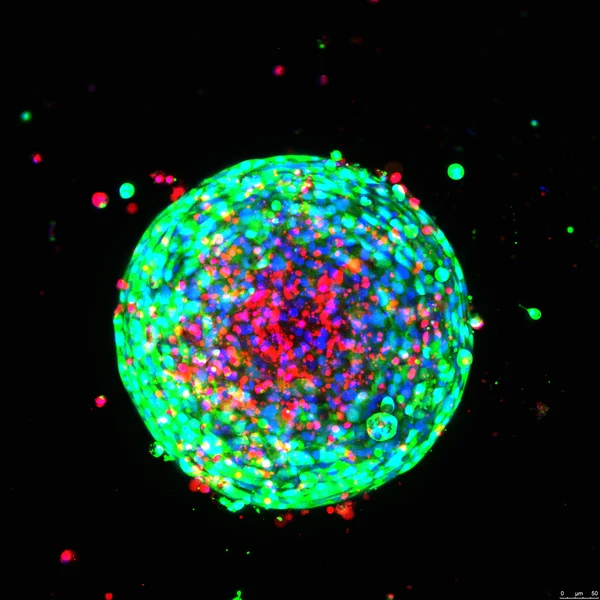 Non-small cell lung cancer spheroid after photodynamic therapy — calcein AM (metabolic activity, green), propidium iodide (dead cells, red), Hoechst (nuclei, blue)